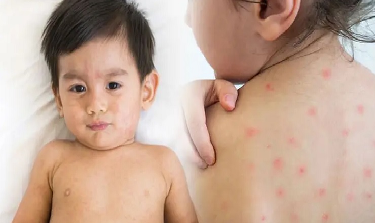 হামের উপসর্গ নিয়ে আরও ১১ শিশুর মৃত্যু