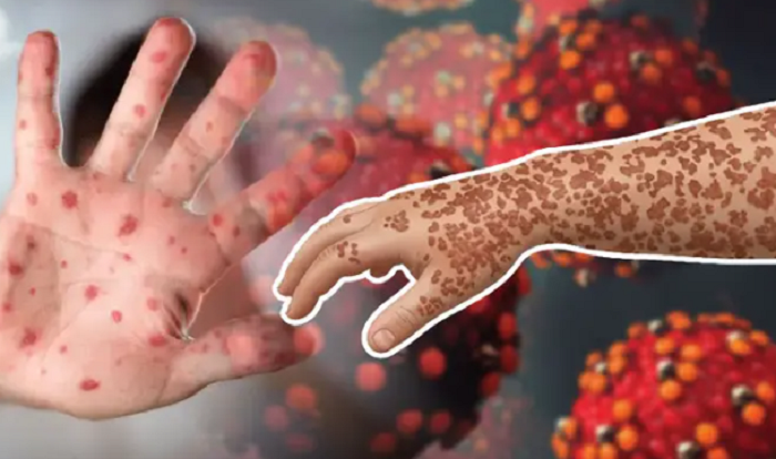 হাম ও হামের উপসর্গ নিয়ে দেশে আরও ১১ শিশুর মৃত্যু