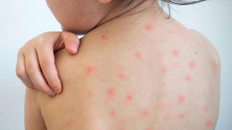 হাম ও হামের উপসর্গ নিয়ে আরও ৭ শিশুর মৃত্যু